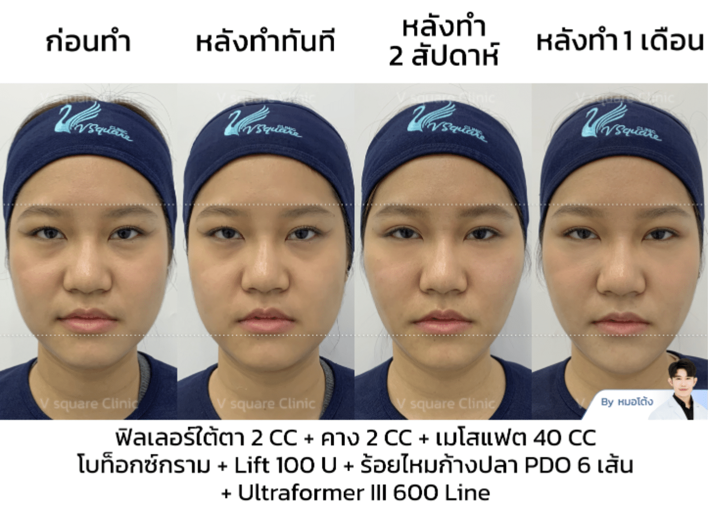 รีวิว Ultraformer III_แจน Influencer โดยนพ.สิทธินันท์