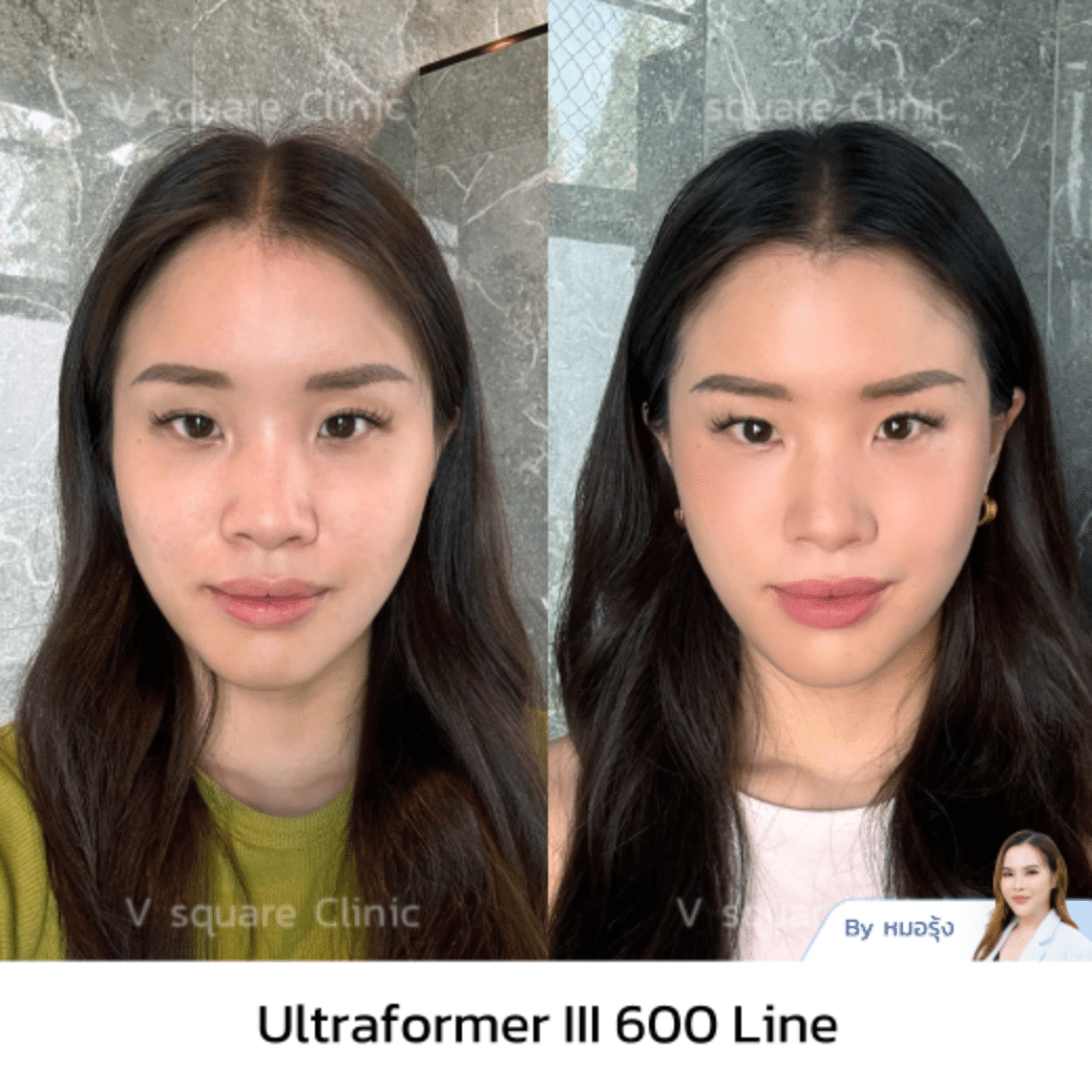 หลังทำ Ultraformer III_คุณแน้น Influencer โดยพญ.นฤมล