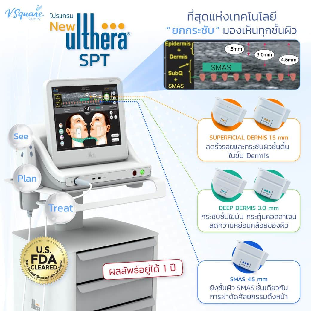 หัวยิง Ulthera