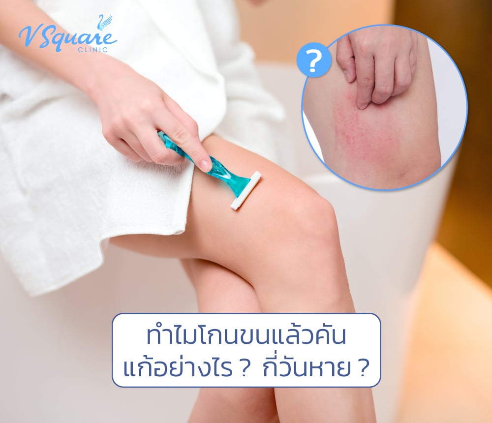โกนขนแล้วคัน