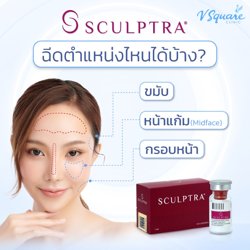 Sculptra ฉีดตำแหน่งไหนได้บ้าง