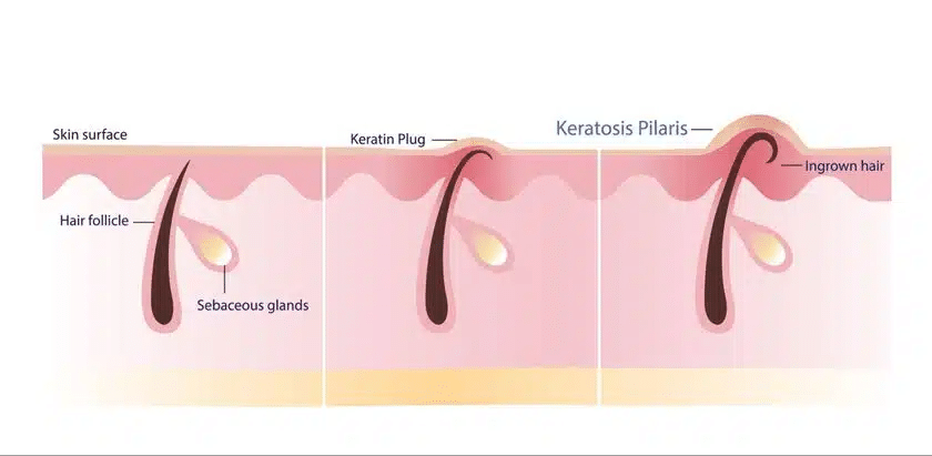 ขนคุด Keratosis Pilaris