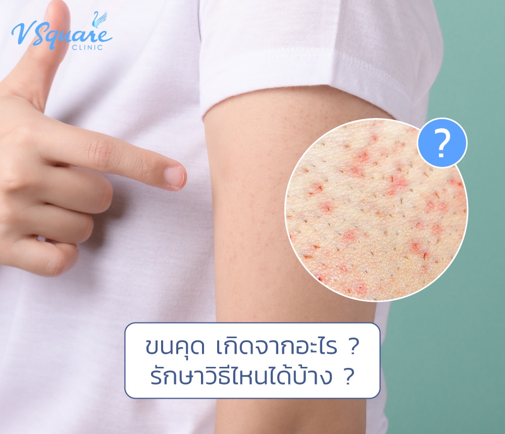 ขนคุด