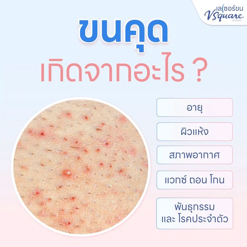 ขนคุดเกิดจาก