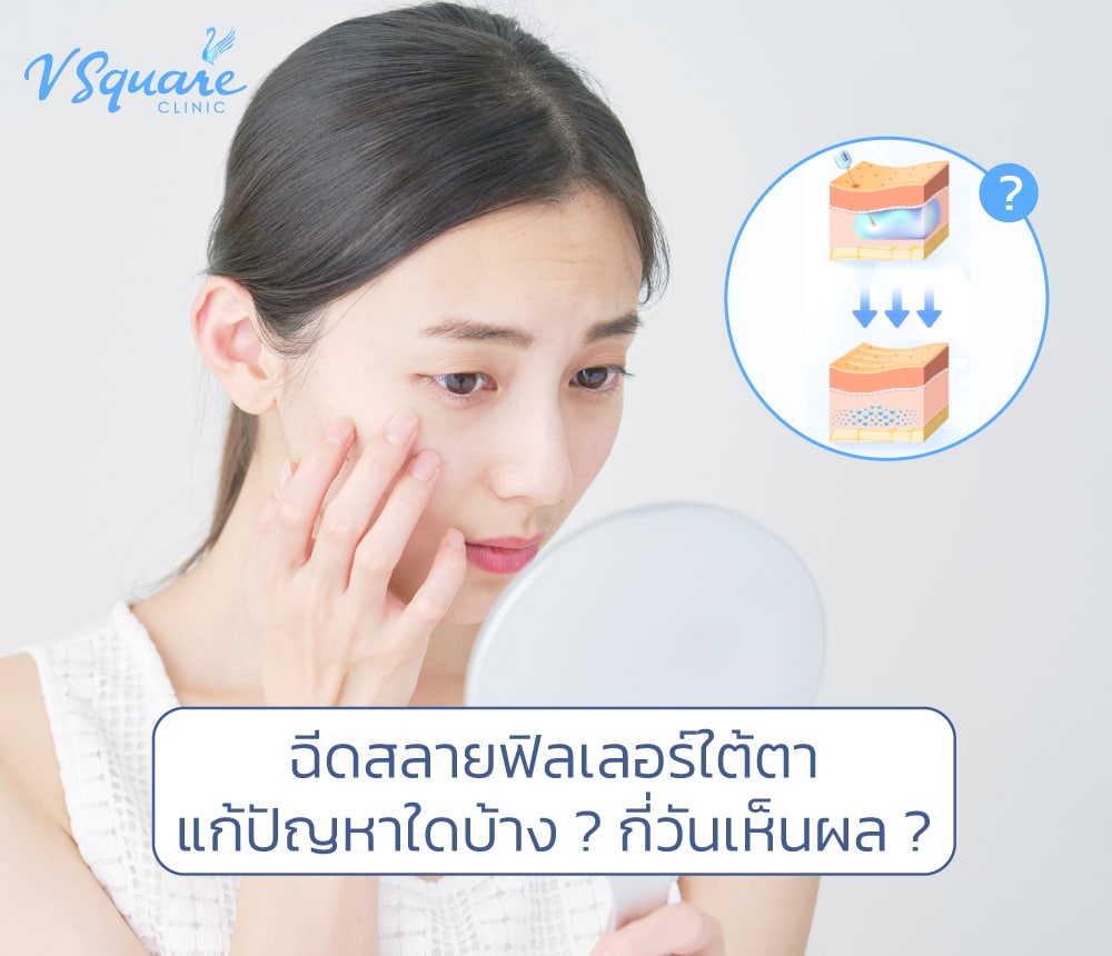 ฉีดสลายฟิลเลอร์ใต้ตา