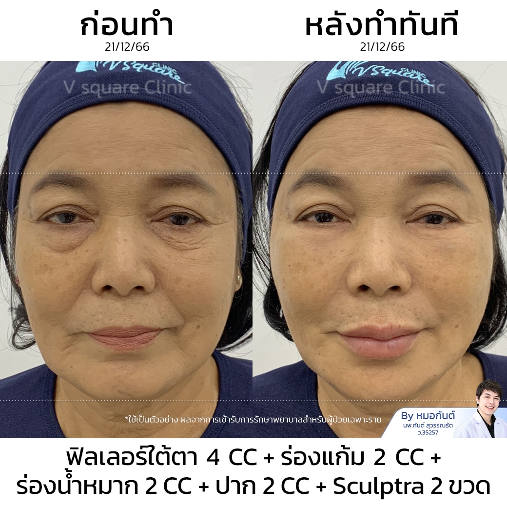 รีวิว Sculptra เคสหมอกันต์_แม่แรม