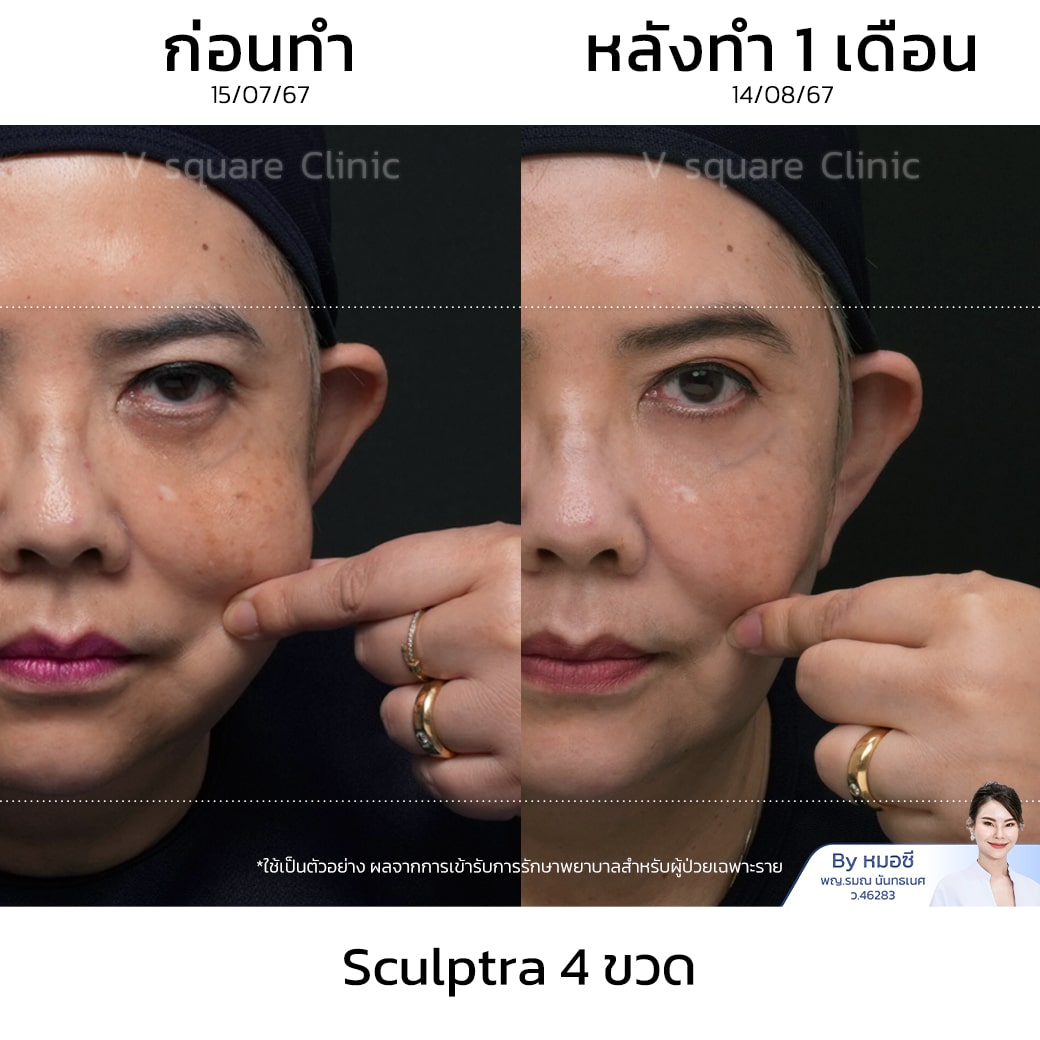 รีวิว Sculptra เคสหมอซี_พี่ยุ้ย