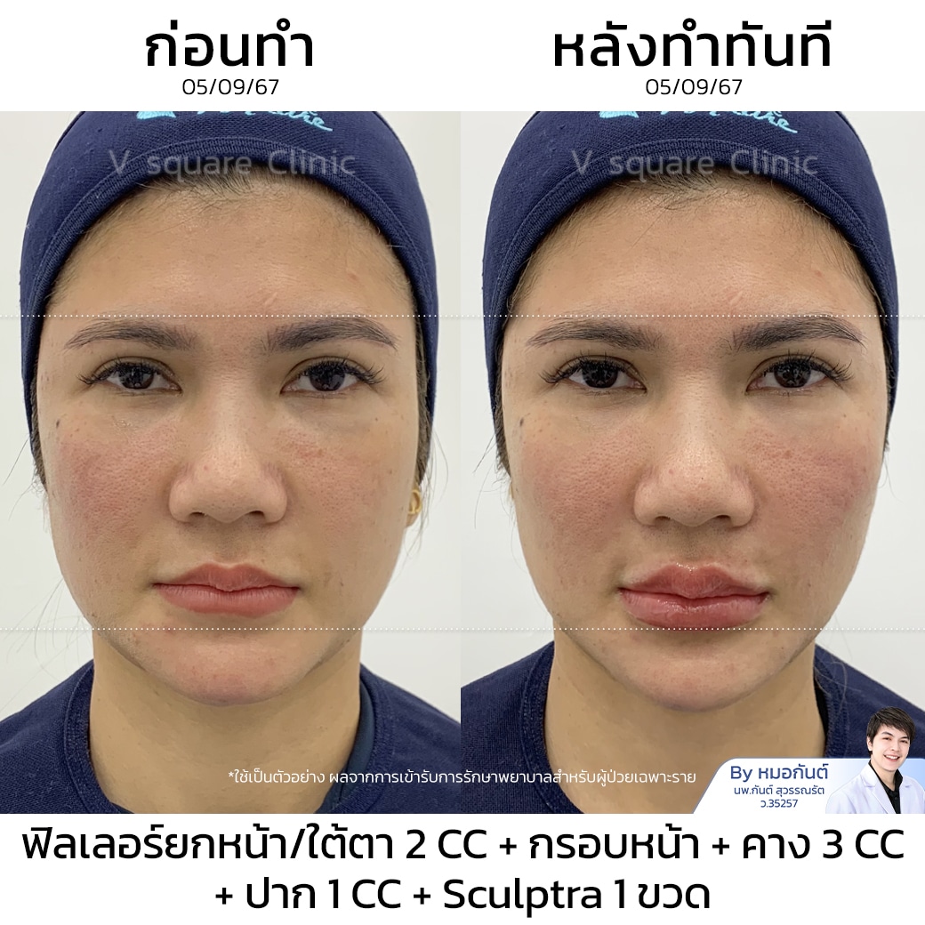 รีวิว sculptra_ทนายนิด้า