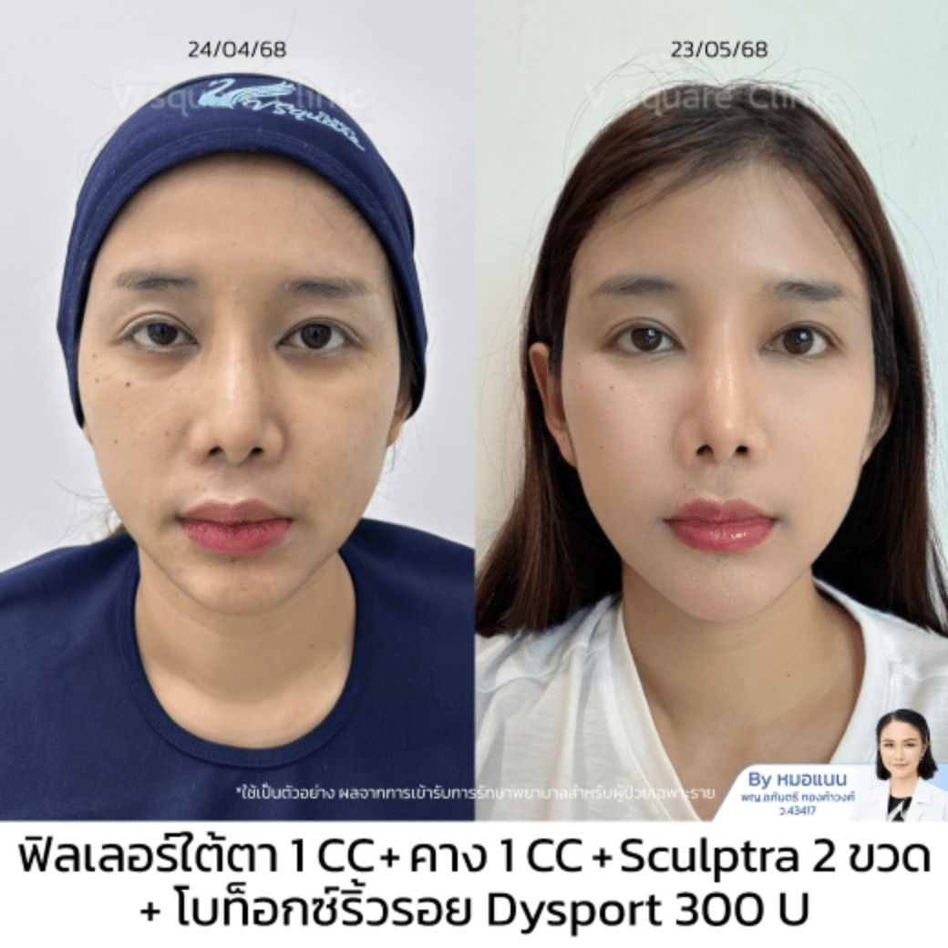 รีวิว sculptra_นัชชา