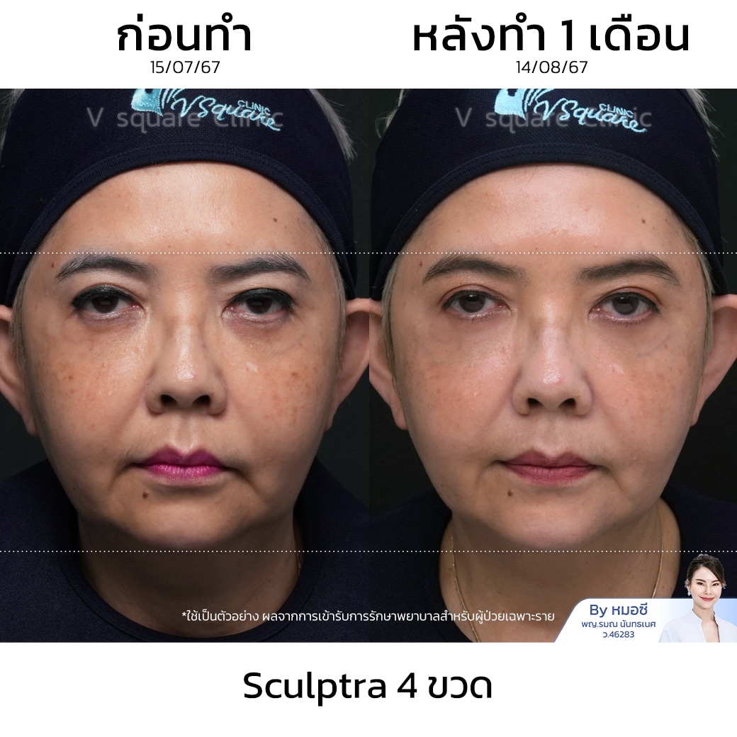 รีวิว sculptra_พี่ยุ้ย