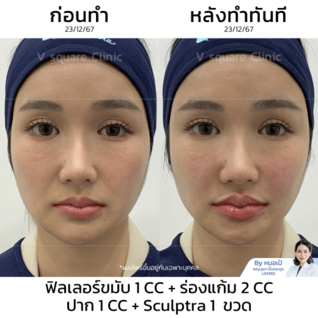 รีวิว sculptra_พี่เจน