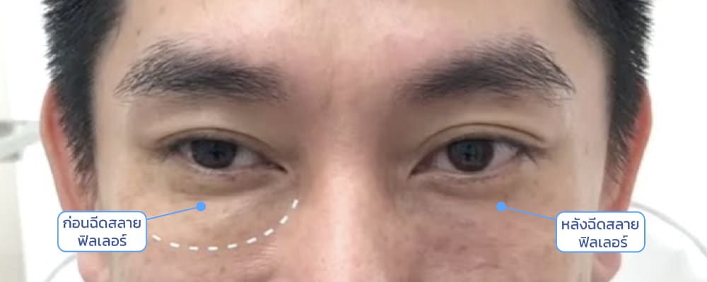 รีวิว ฉีดสลายฟิลเลอร์ใต้ตา