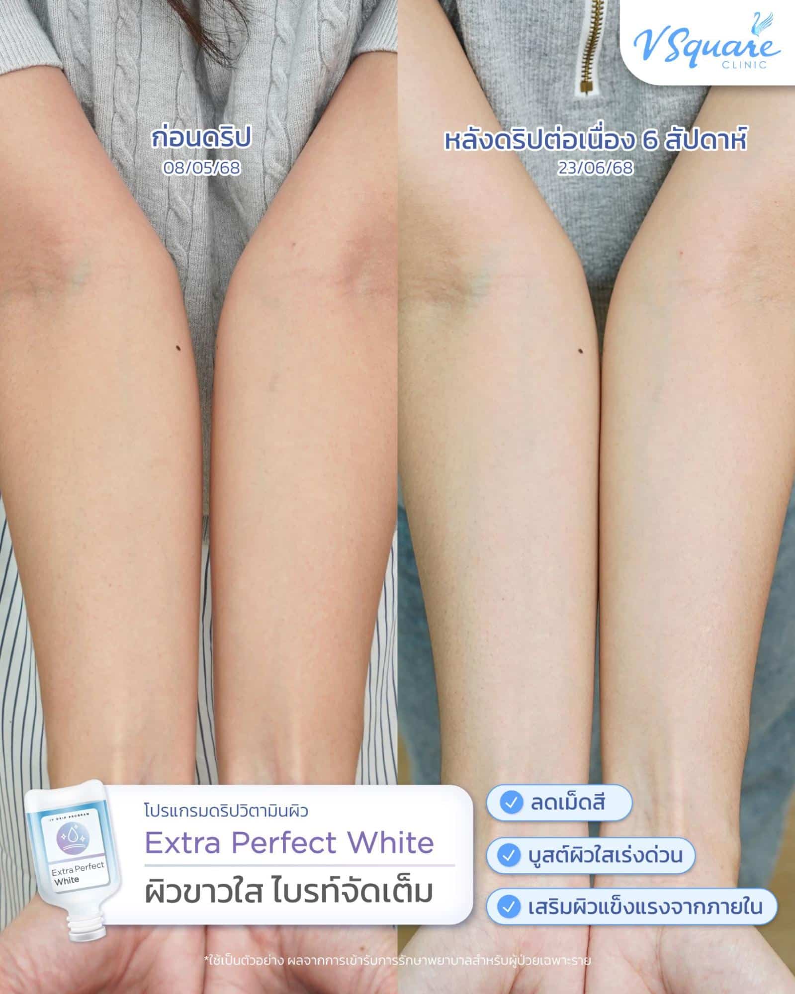 รีวิวดริปวิตามินผิวขาว