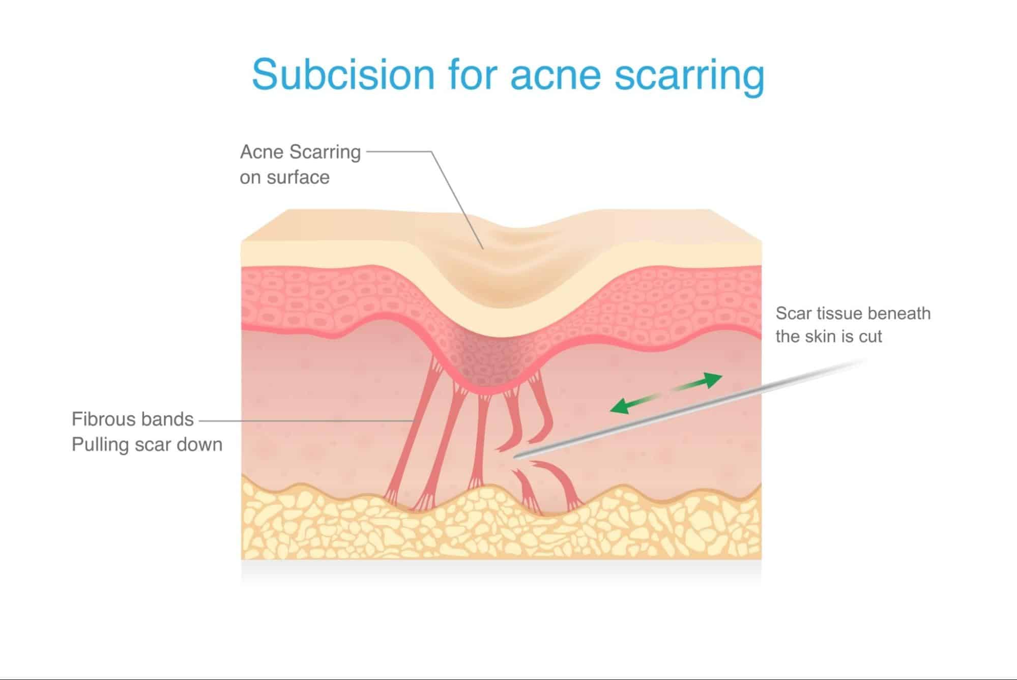 Subcision คืออะไร