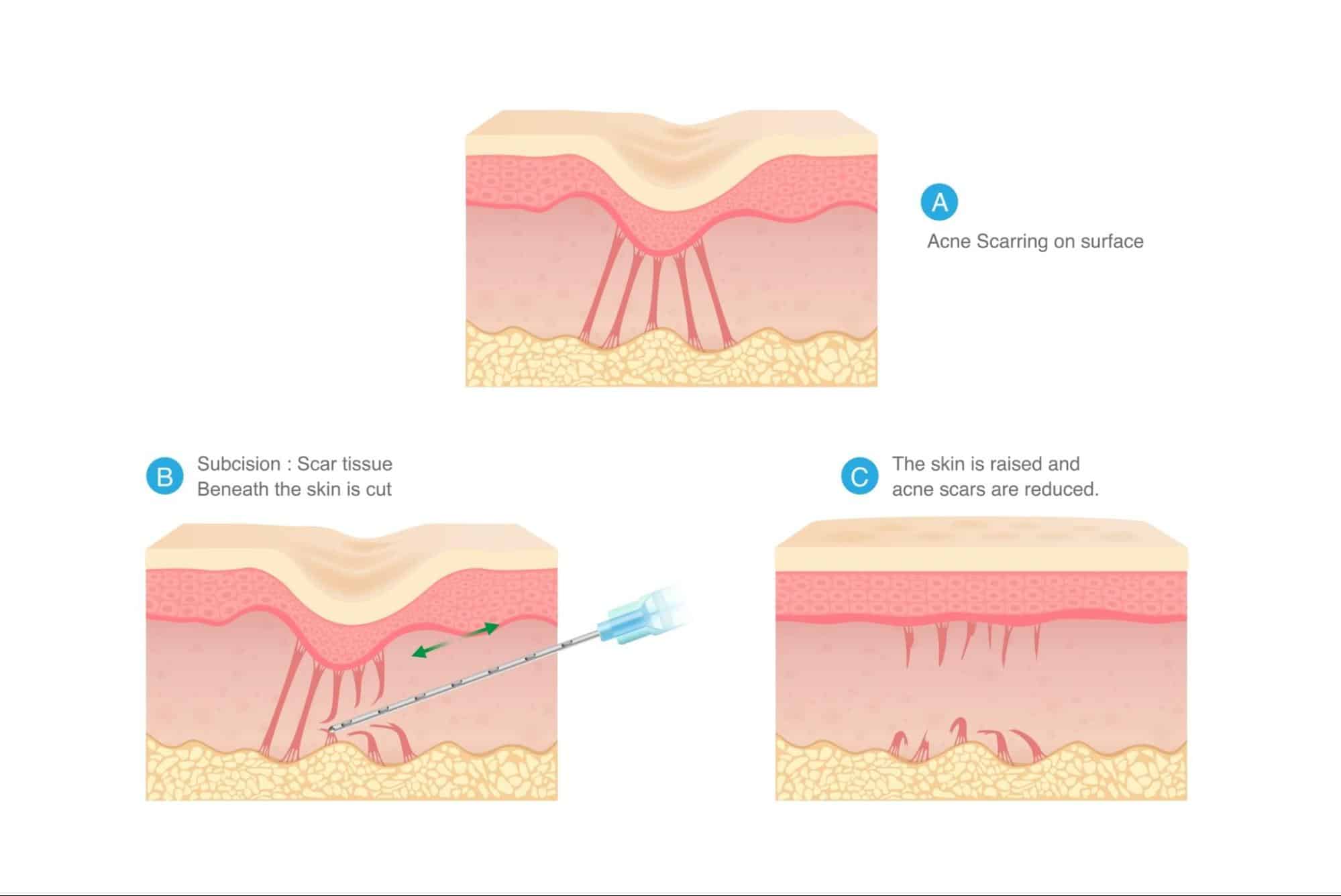 ขั้นตอนการทำ Subcision หลุมสิว