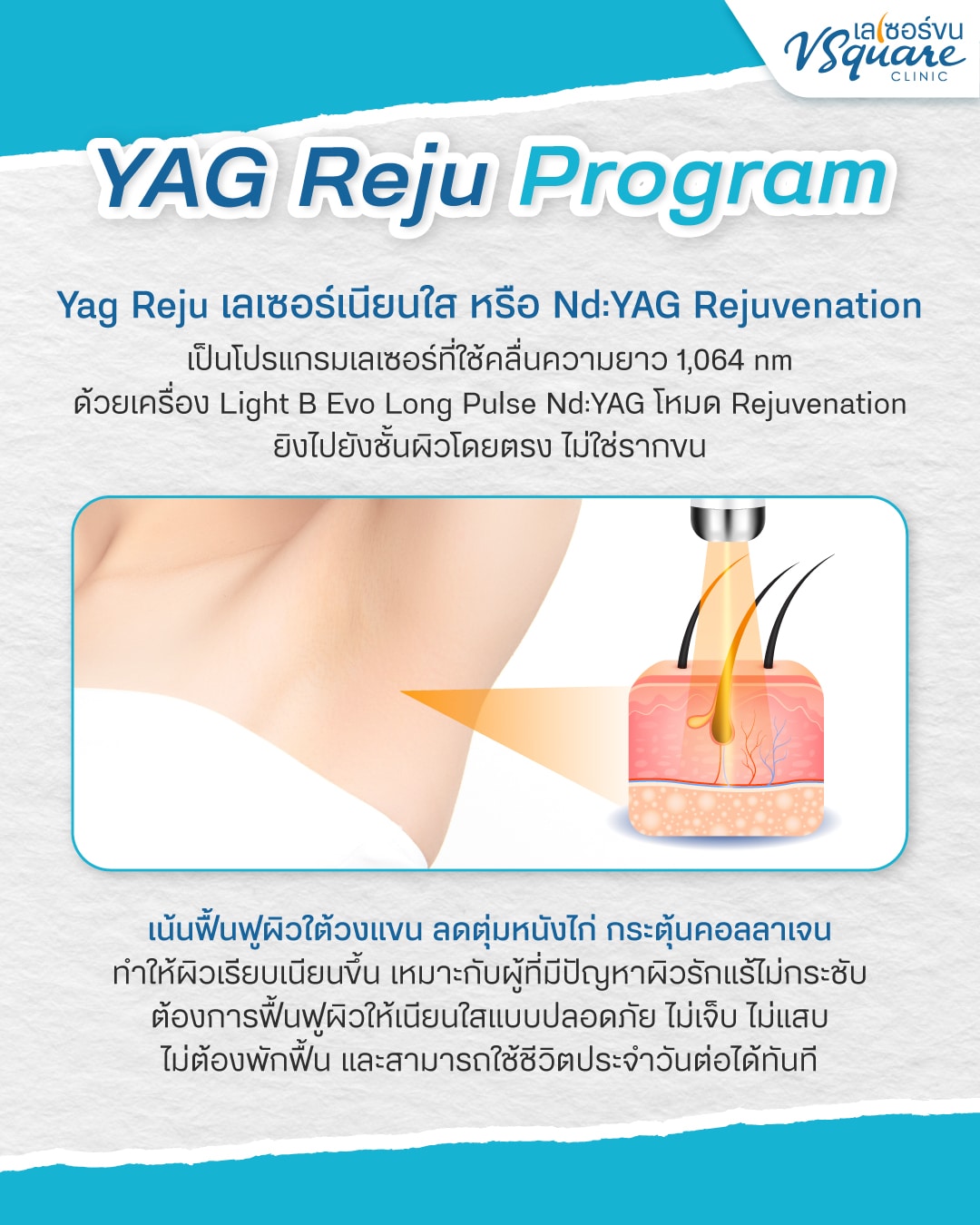เลเซอร์เนียนใส YAG Reju
