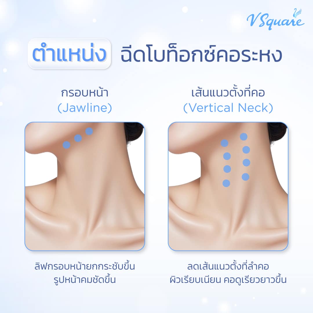 จุดฉีดโบท็อกคอระหง