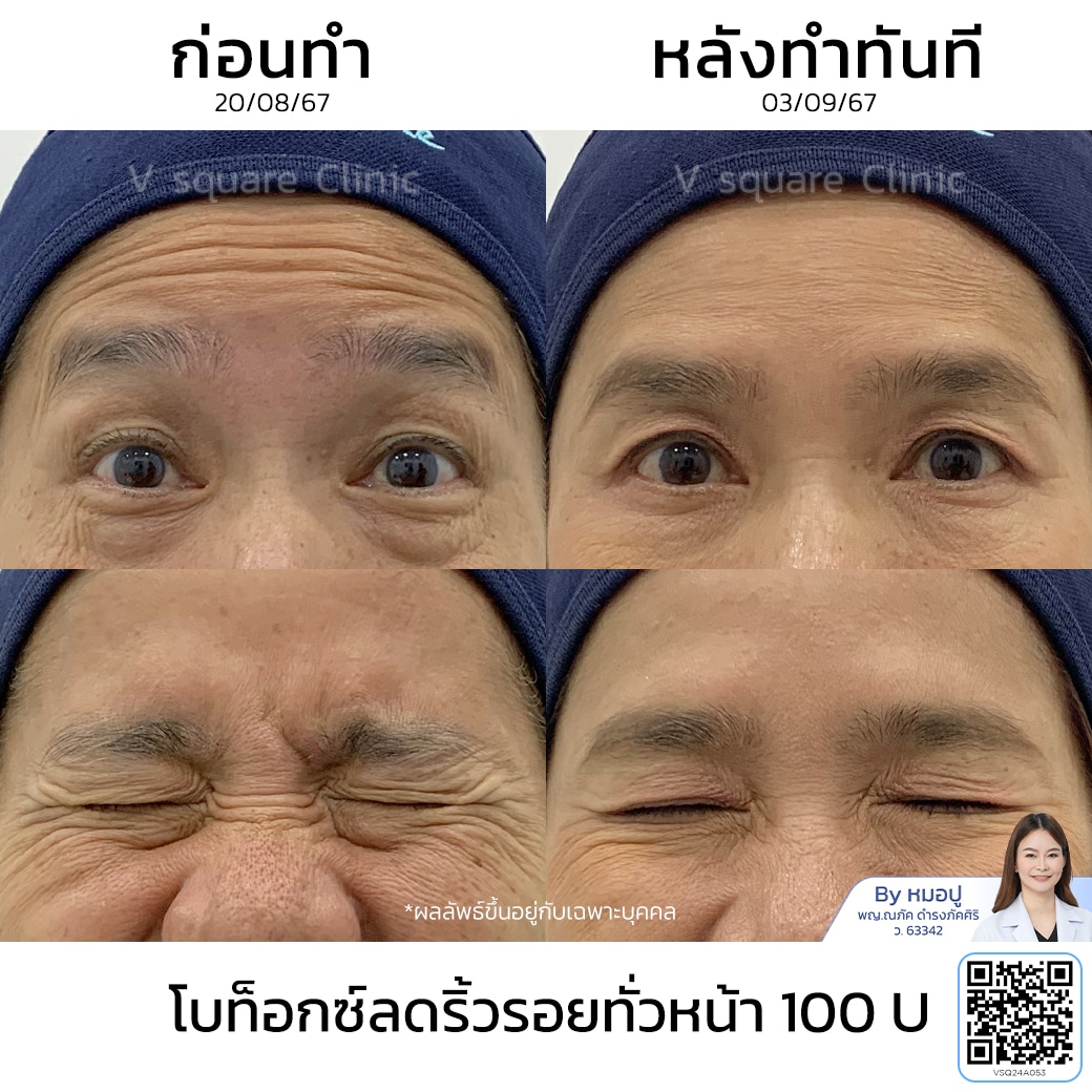 รีวิวฉีดโบท็อกริ้วรอย_คุณชมพู่