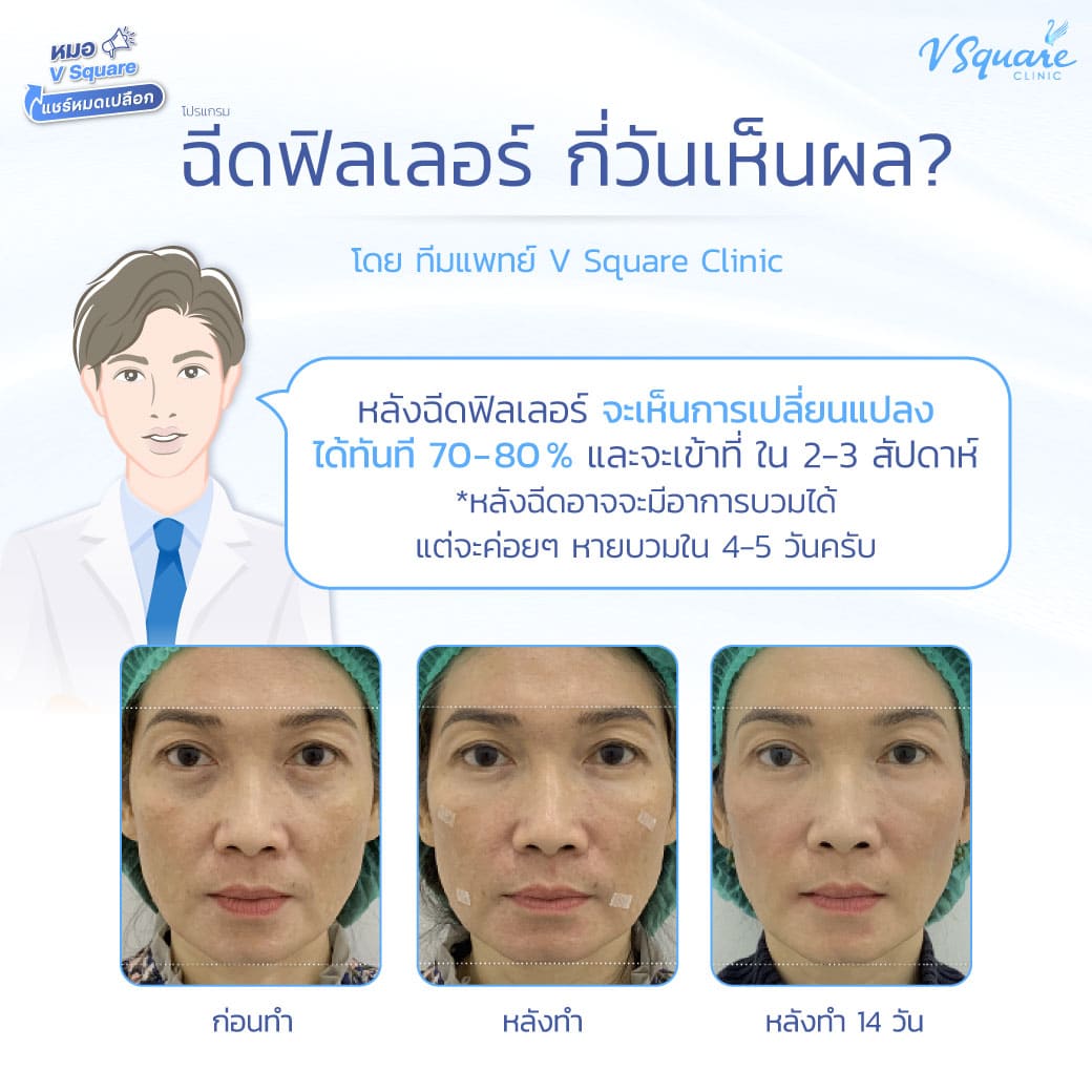 หลังฉีด Jalor Filler กี่วันเห็นผล