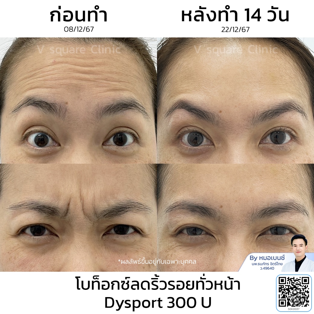 โบท็อกริ้วรอย รีวิว_คุณจุฑามาศ