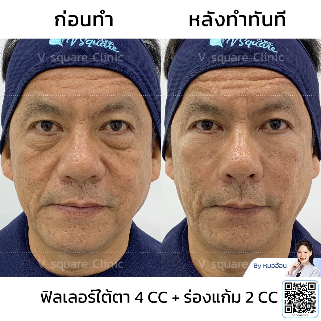 ฉีดฟิลเลอร์ผู้ชาย รีวิว_พ่อโจ โดย พญ.อิษฎา ตระกูลสุข