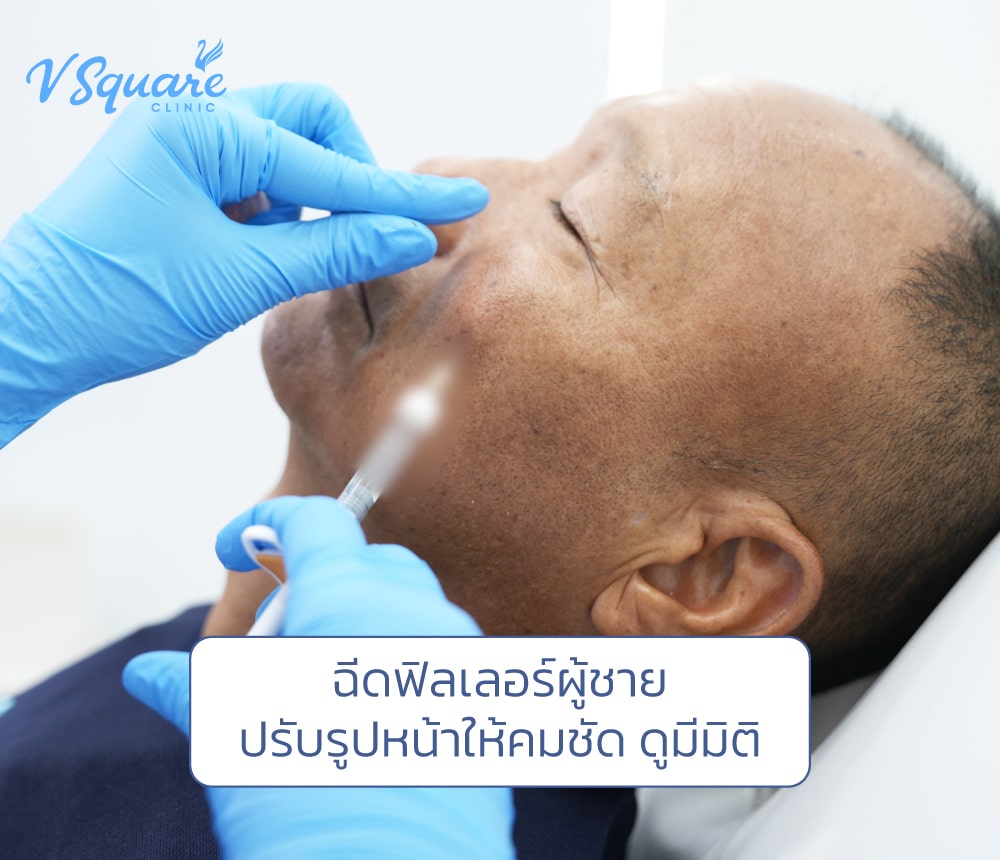 ฉีดฟิลเลอร์ผู้ชาย