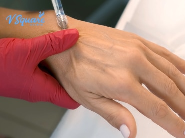 ฉีดฟิลเลอร์มือ 370x277