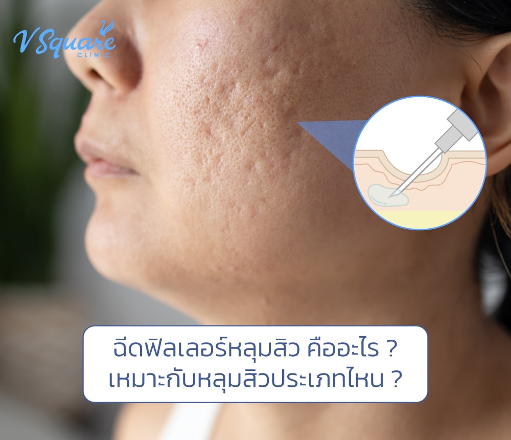 ฉีดฟิลเลอร์หลุมสิว