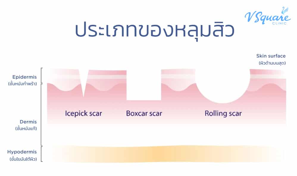 ประเภทหลุมสิว