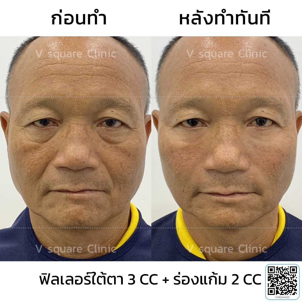 ผู้ชายฉีดฟิลเลอร์ รีวิว_หมวดหม่ำ