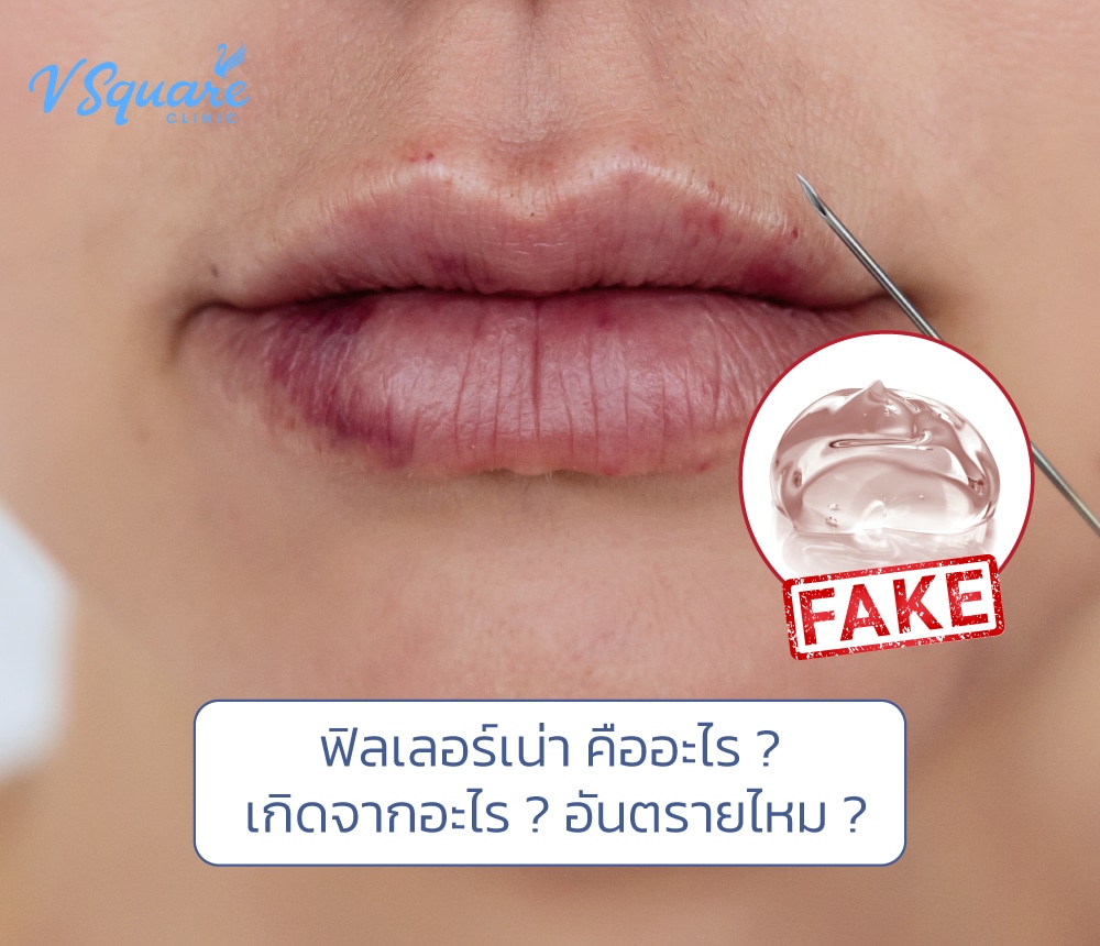ฟิลเลอร์เน่า
