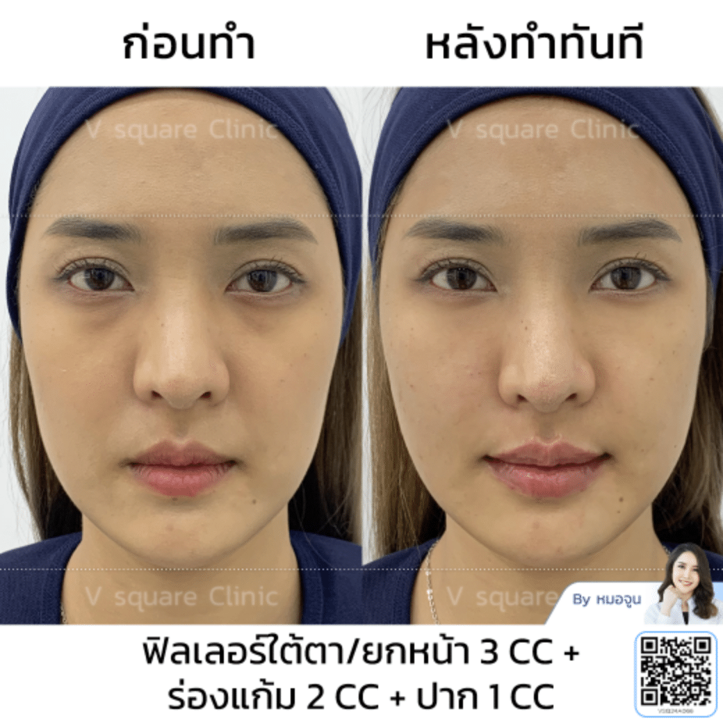รีวิว Filler ปากกระจับ_คุณเนียร์ โดย หมอ จูน