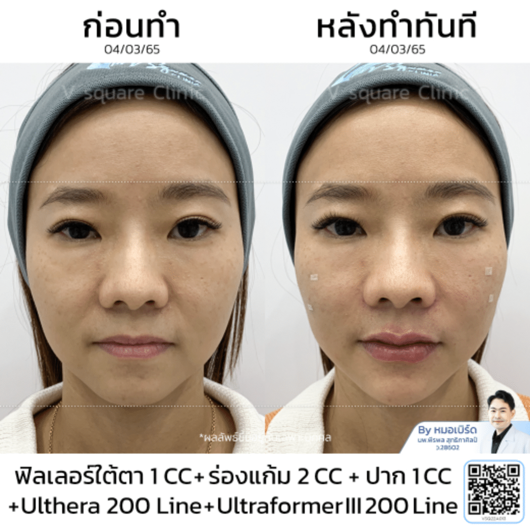 รีวิว Ulthera รอบดวงตา_คุณแสง โดย หมอ เบิร์ด