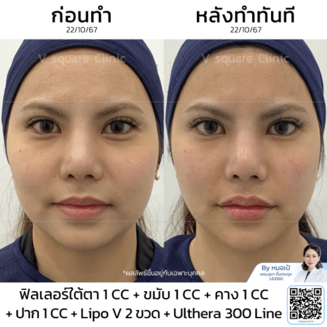 รีวิว Ulthera รอบดวงตา_ใบเตย โดย หมอ เป้