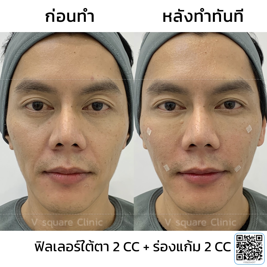 รีวิว ผู้ชายฉีดฟิลเลอร์_พี่เอ็ม