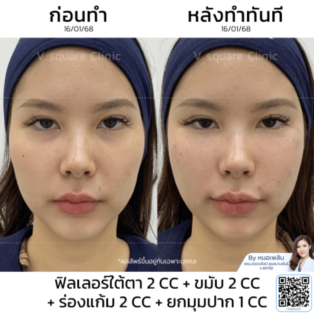 รีวิวทรงปากกระจับ_คุณเฟิร์น Influencer โดย หมอ เพลิน