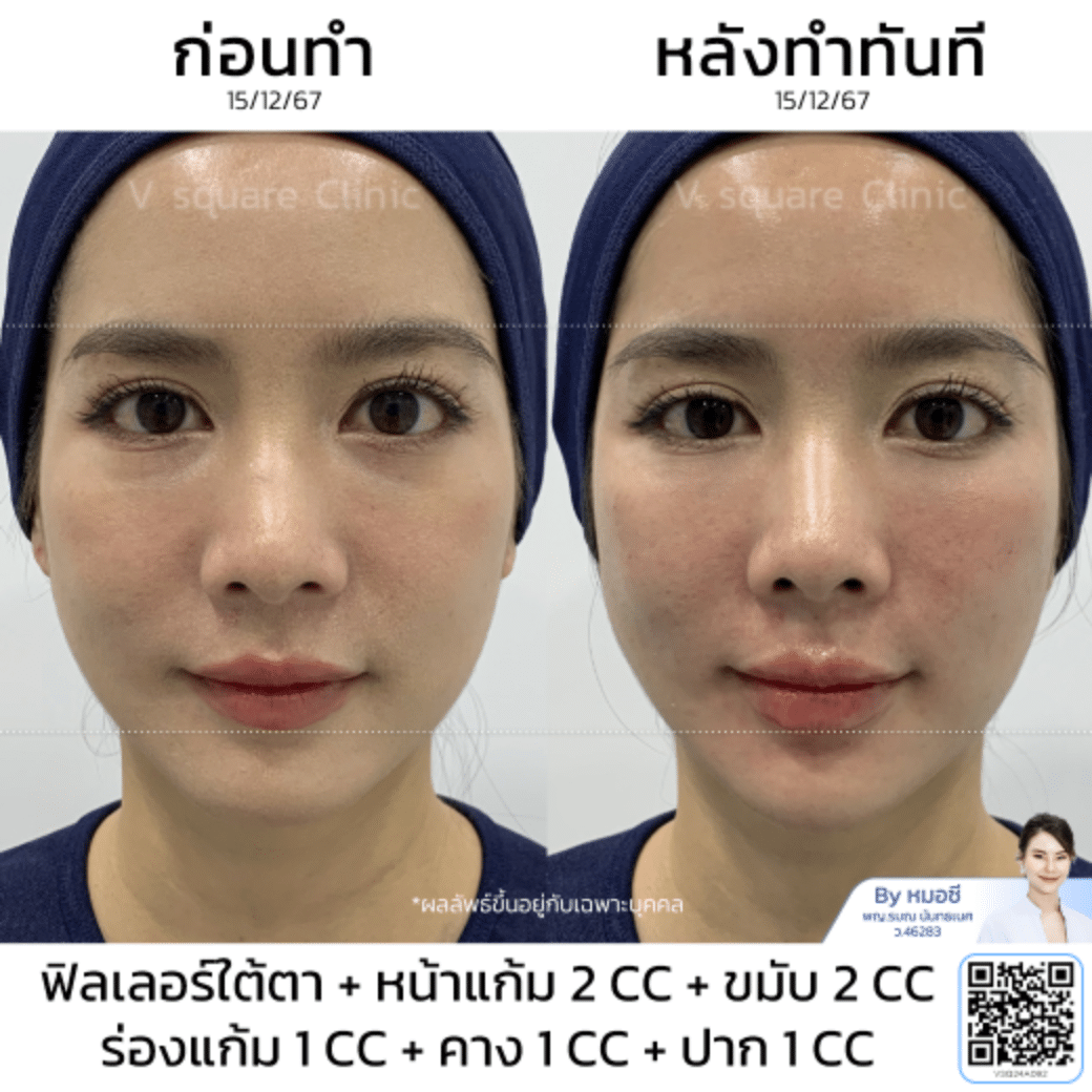 รีวิวปากกระจับ_คุณกุ๊กกิ๊ก โดย หมอ ซี