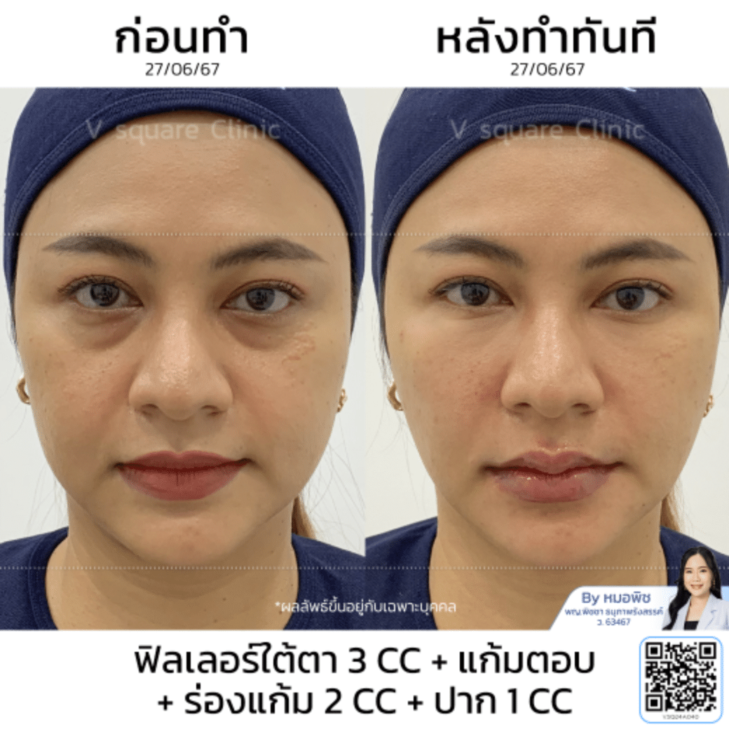 รีวิวปากกระจับ_คุณแอน โดย หมอ พิช
