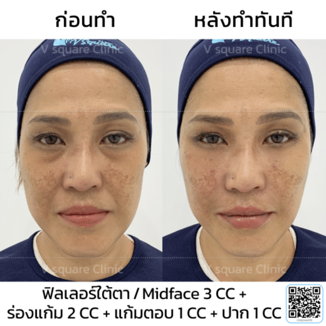 รีวิวฟิลเลอร์แก้มตอบ_คุณนุ้ย
