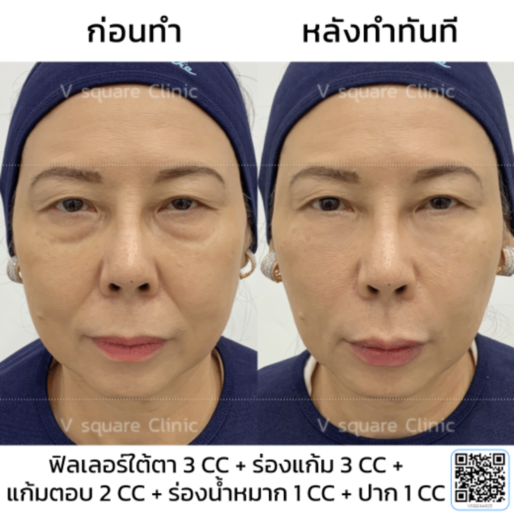 รีวิวฟิลเลอร์แก้มตอบ_คุณนุ้ย