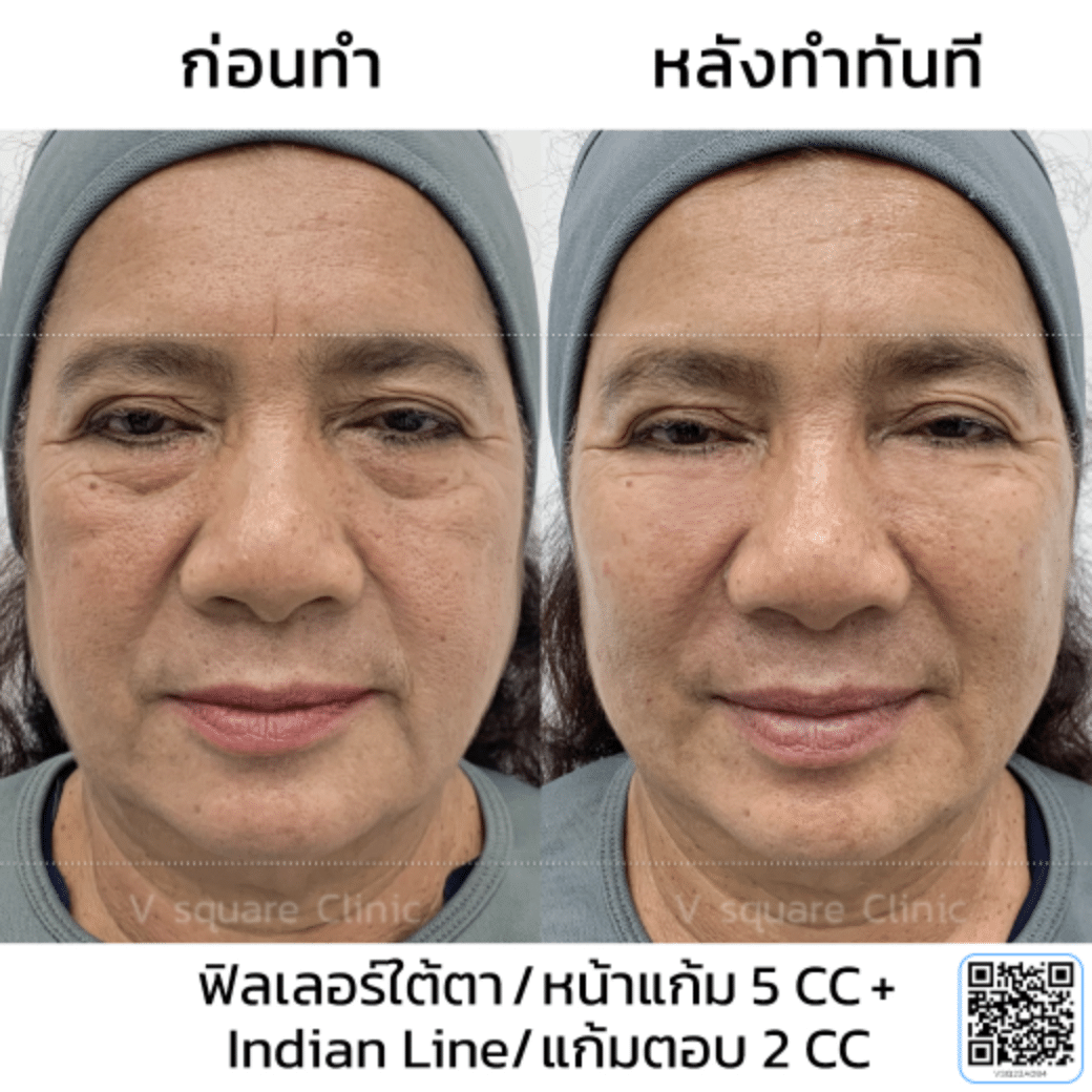 รีวิวฟิลเลอร์แก้มตอบ_แม่น้ำใจ