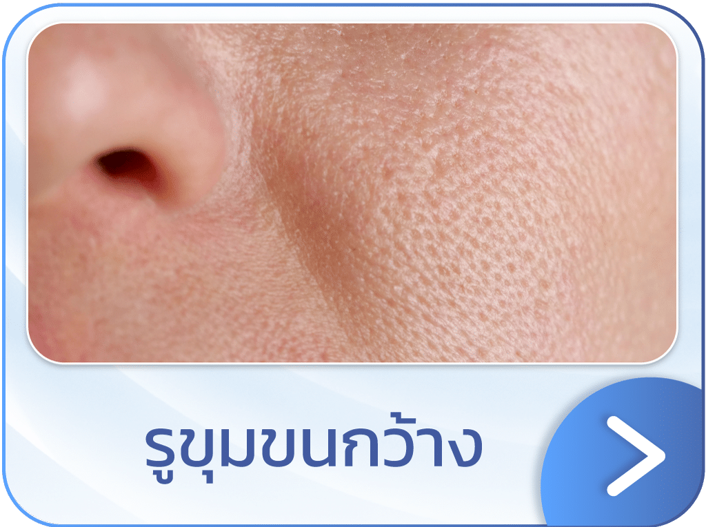 Discovery Pico รูขุมขนกว้าง
