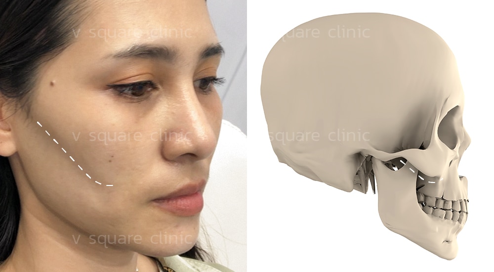สาเหตุแก้มตอบ เกิดจากอะไร