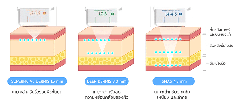 หลักการทำงานของ Ulthera รอบดวงตา