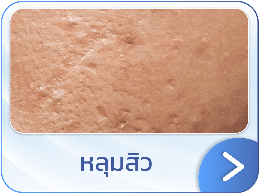 Discovery Pico หลุมสิว