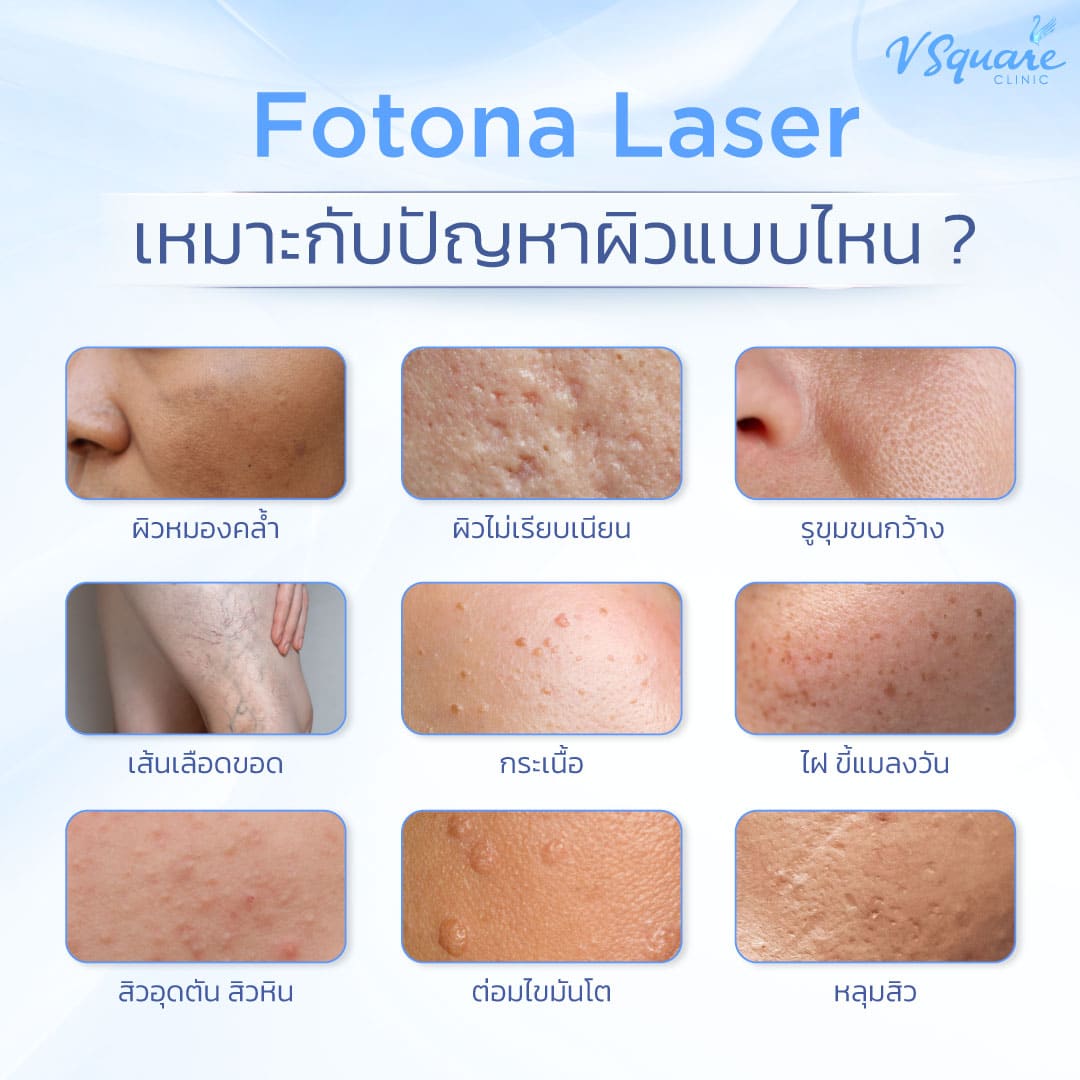Fotona Laser Reju ปัญหาผิว