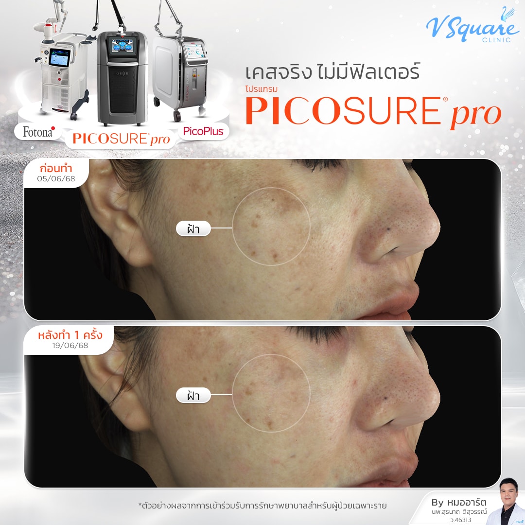 Reju Laser รีวิว_คุณแพรวนภา โดย หมออาร์ต