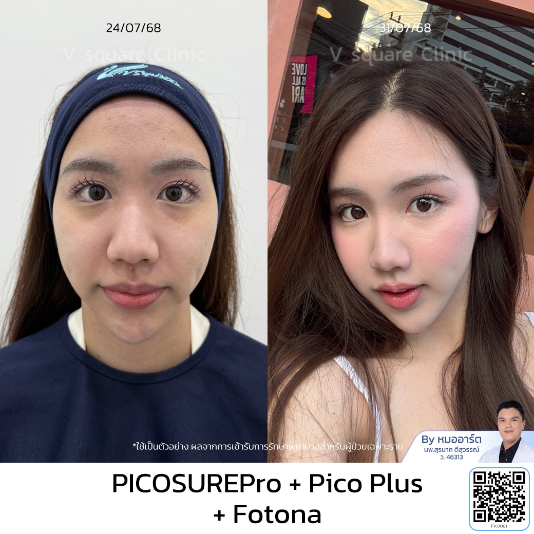 รีวิวโปรแกรม Laser Reju_เนย โดย หมออาร์ต
