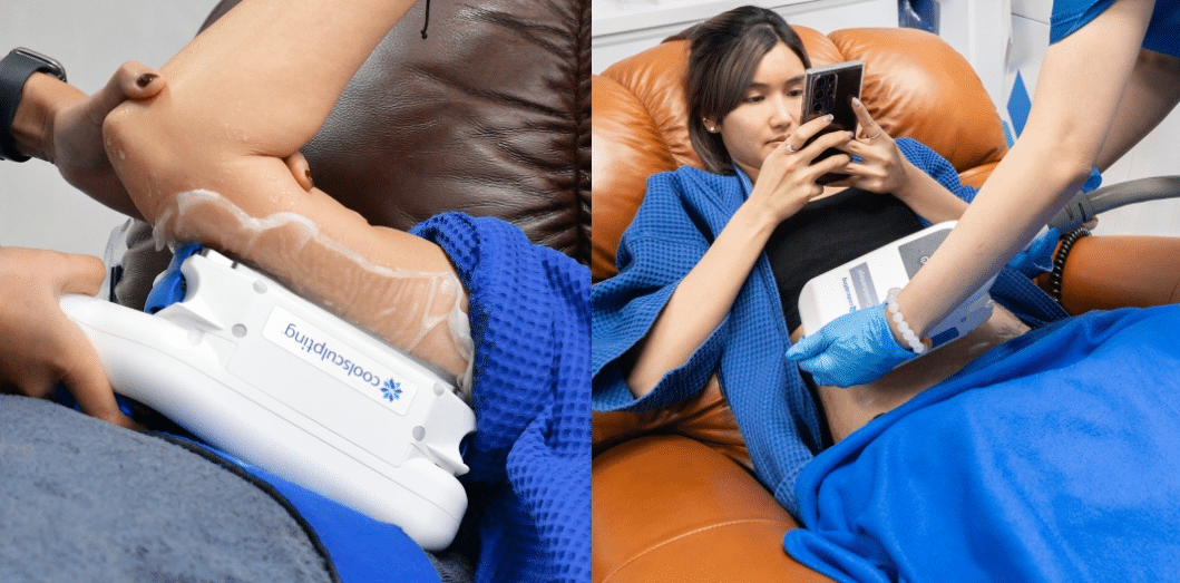 Coolsculpting V Square ลดผลข้างเคียง