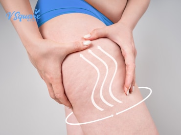 Coolsculpting สลายไขมันต้นขา คือ 370x277
